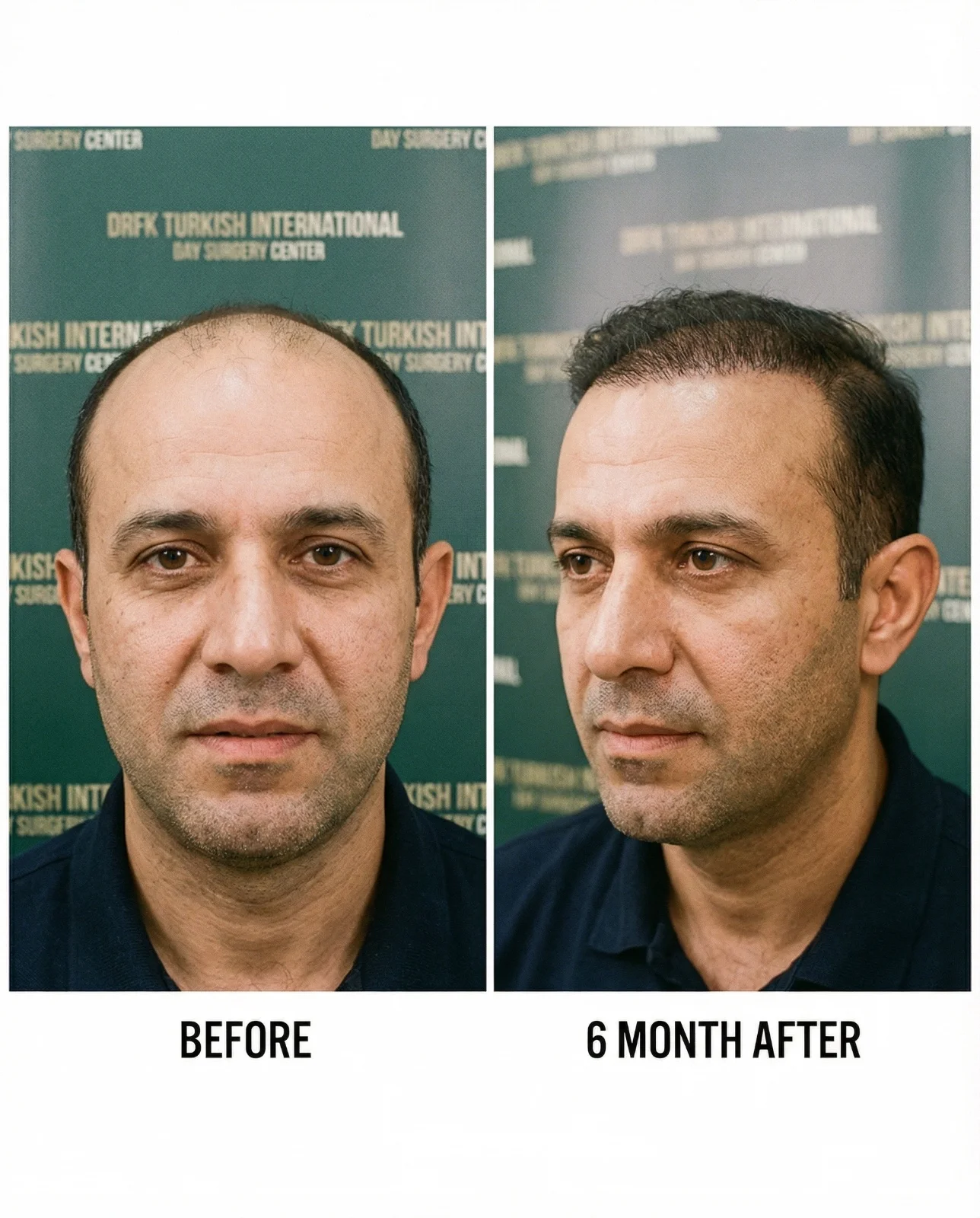 Hair transplant result 1