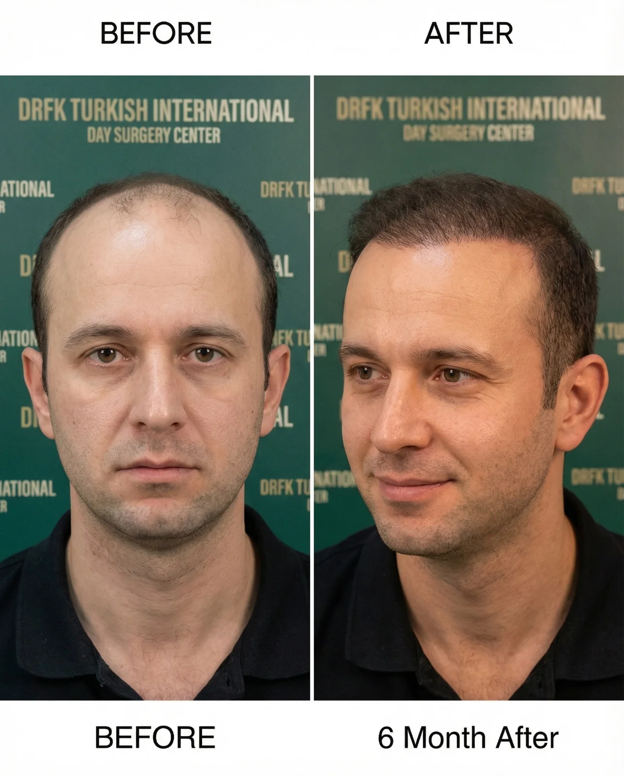 Hair transplant result 2