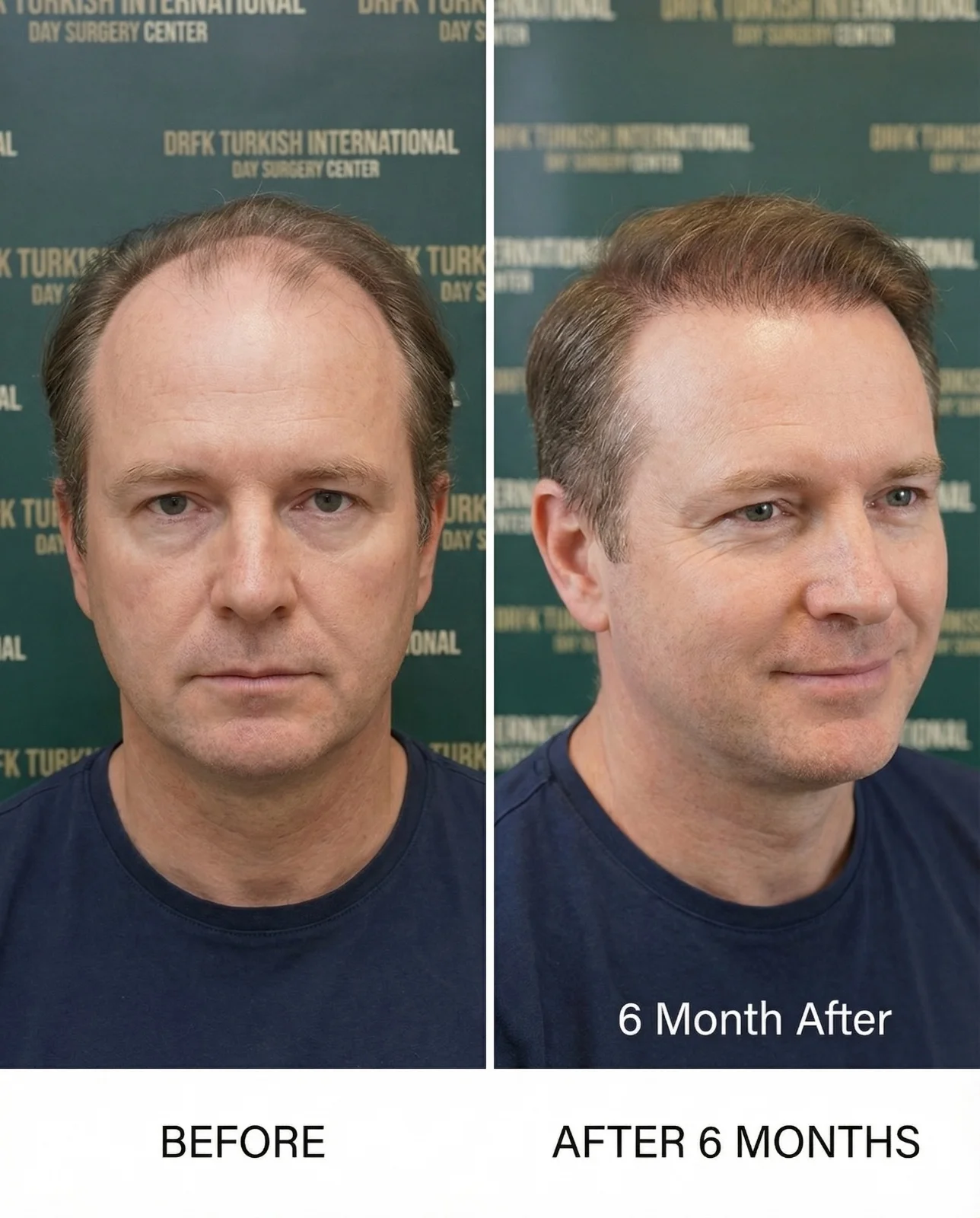 Hair transplant result 5