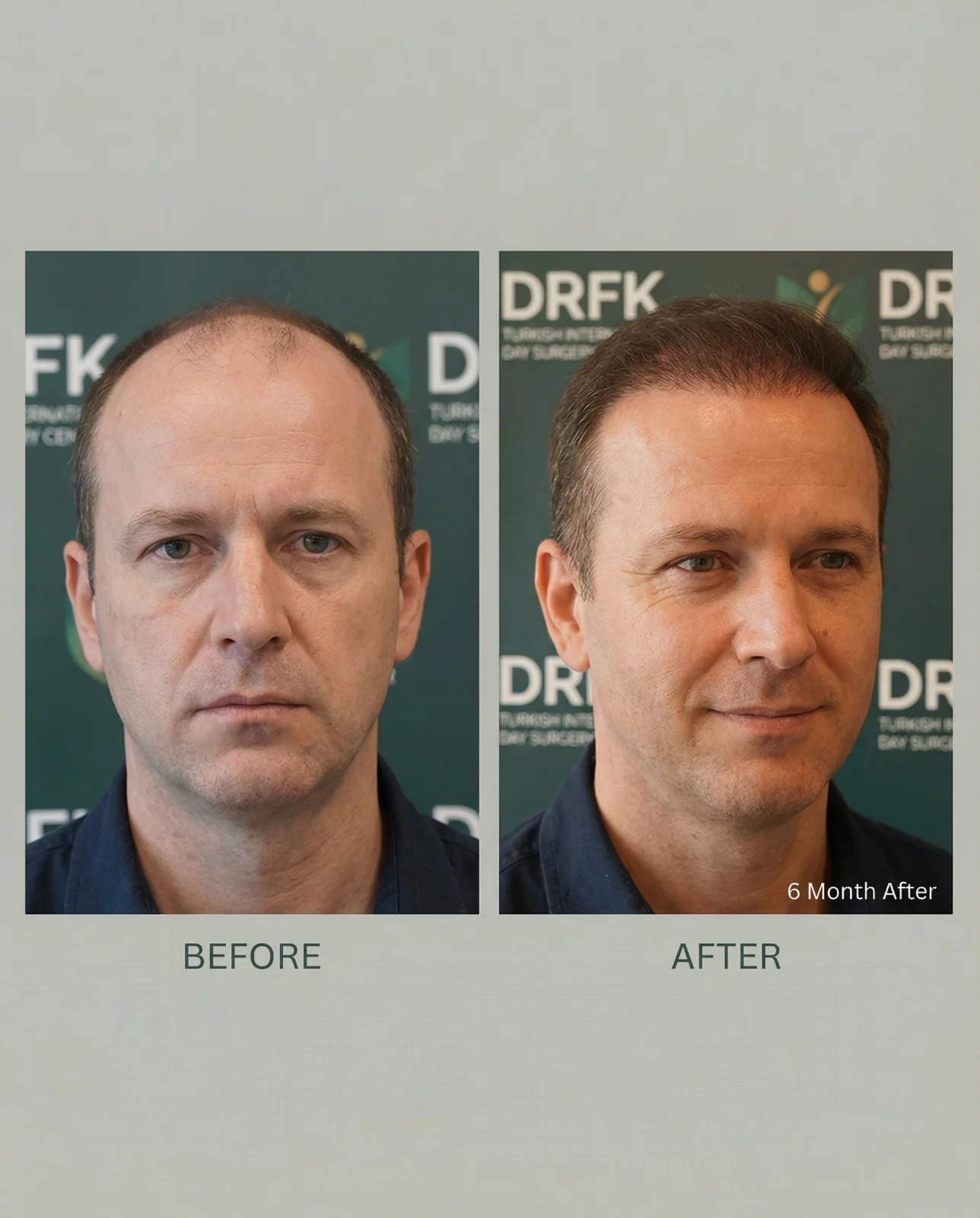 Hair transplant result 6