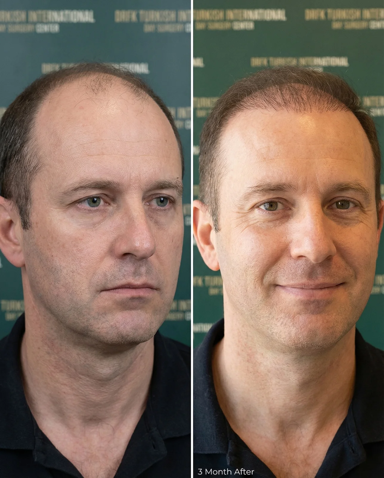 Hair transplant result 7