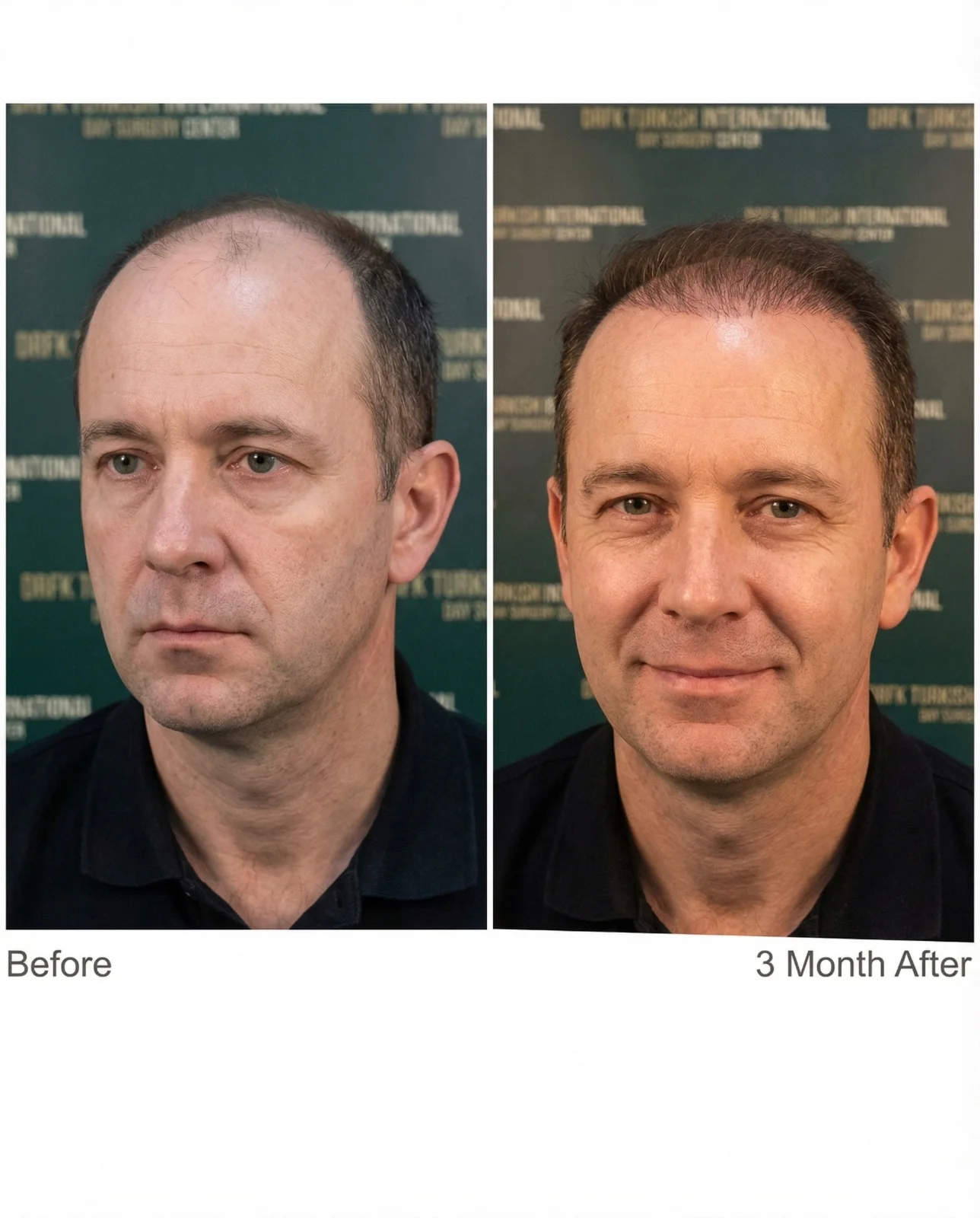 Hair transplant result 8