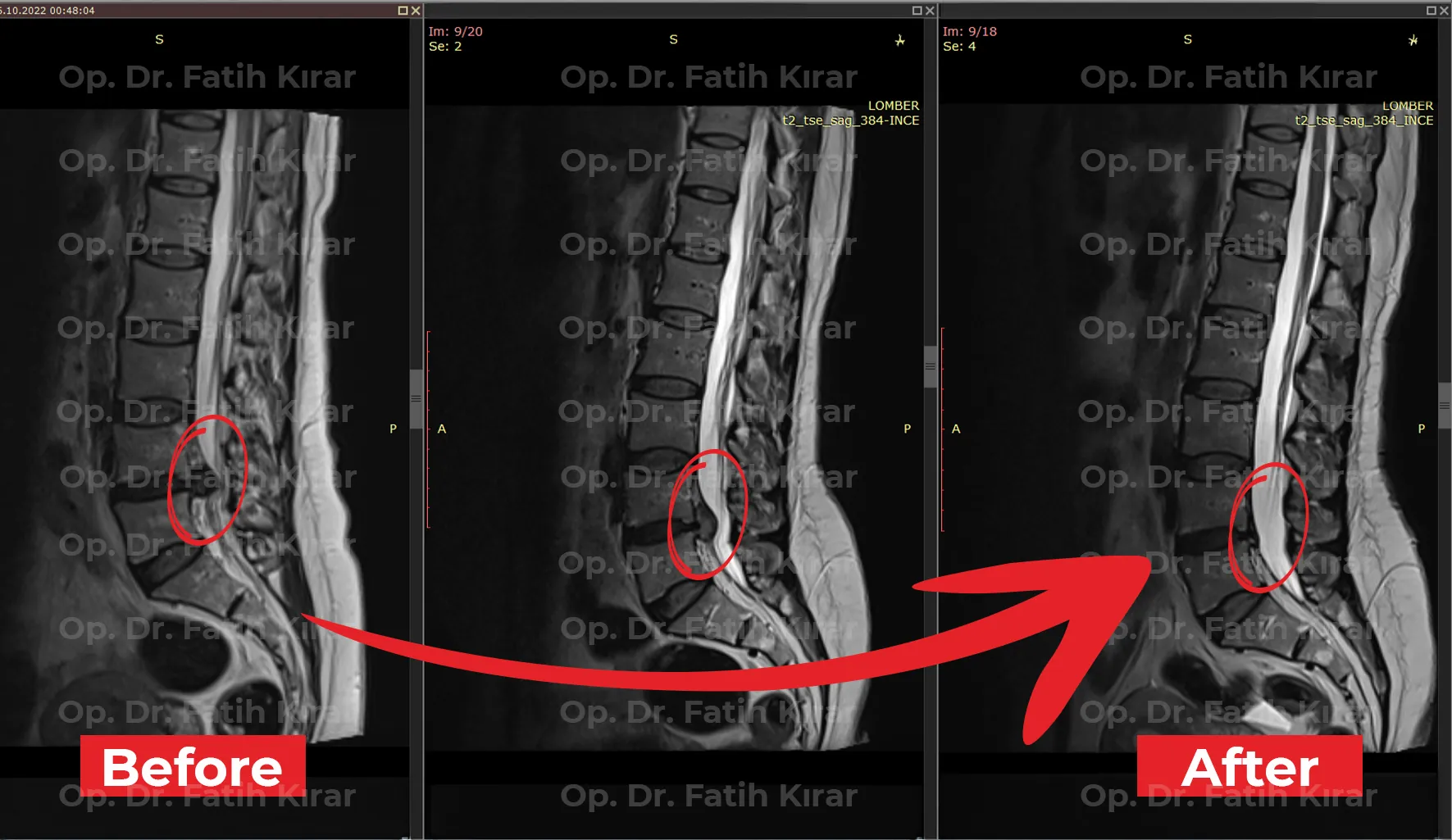 Spine treatment MRI comparison - Clinical outcome