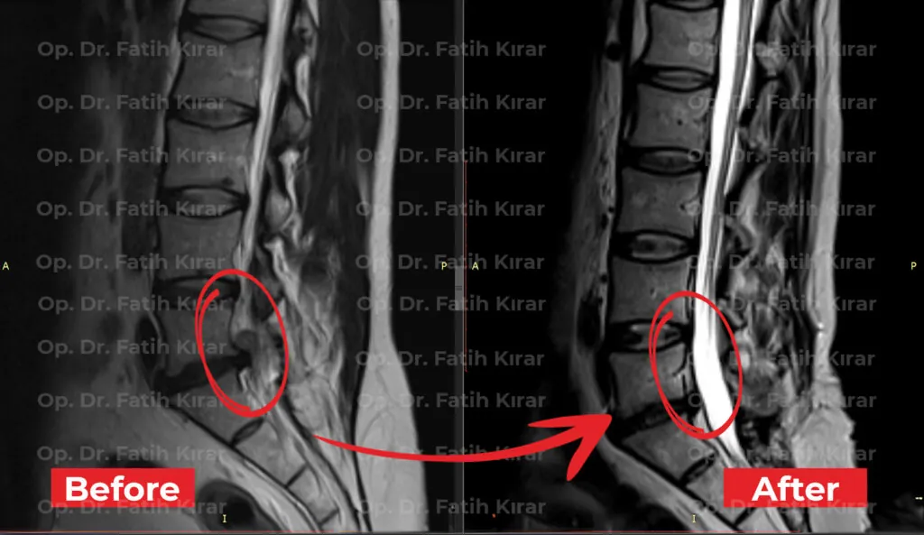 Minimally invasive spine surgery MRI - Recovery progress